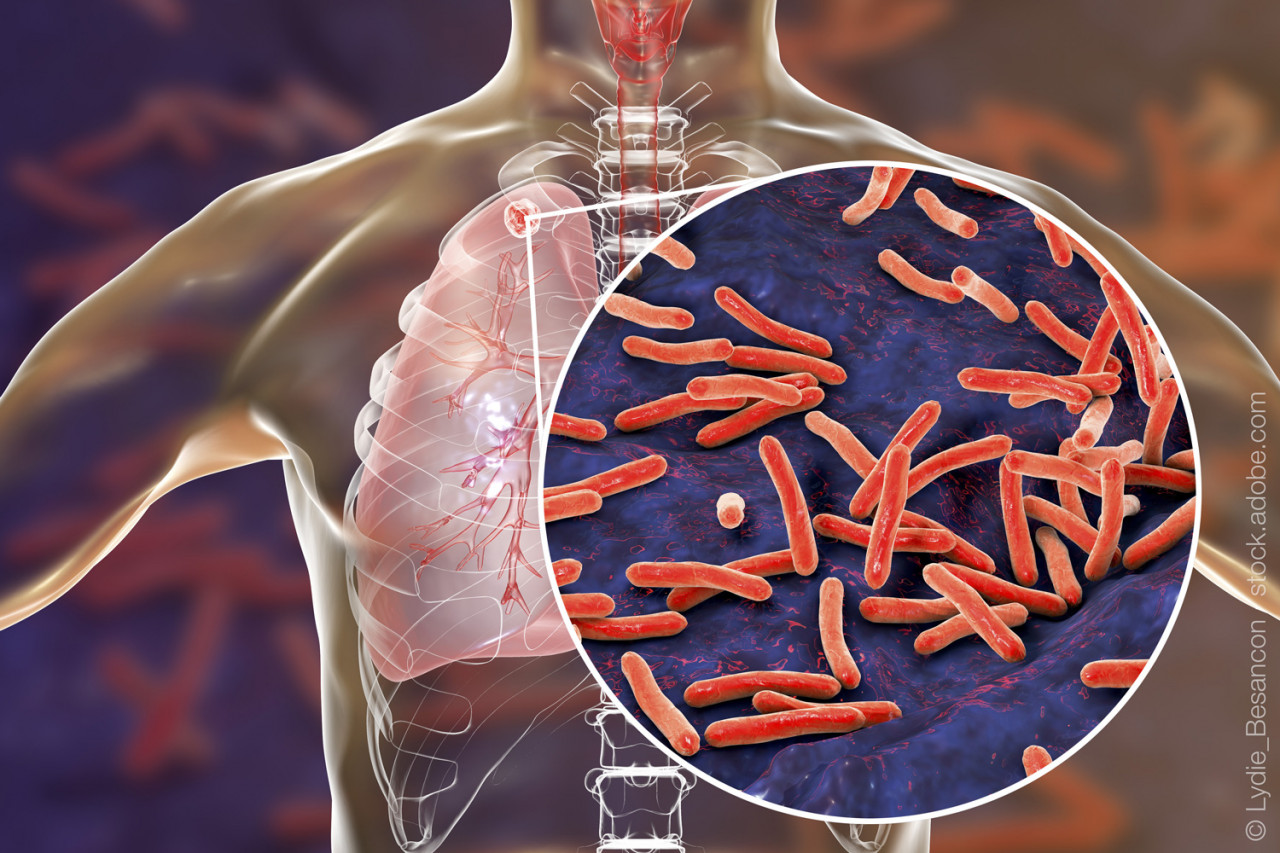 AdobeStock-200411005-Lunge-Tuberculosis-Bacteria-bakterien-Tuberkulose